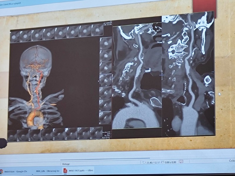 Návštěva iktového centra neurologického oddělení Litomyšlské nemocnice Návštěva iktového centra neurologického oddělení Litomyšlské nemocnice